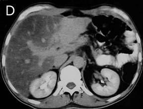 43 Patología del hígado D. HÍGADO GRASO Figura 88. A- Ecografía abdominal: hígado aumentado de tamaño y de ecogenicidad por la infiltración grasa.