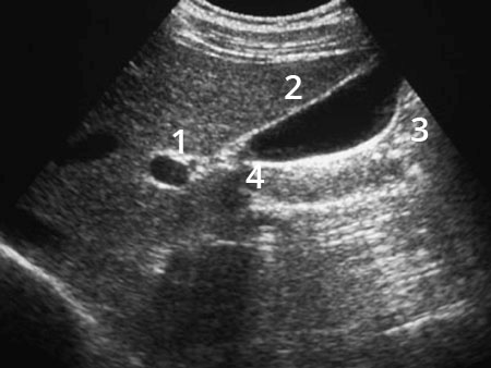 4 Anatomía ecográfica normal Figura 8. Se puede ver: (1) diafragma, (2) psoas, (3) fascia de Gerota entre riñón derecho y lóbulo hepático derecho, (4) riñón derecho y (5) lóbulo hepático derecho.