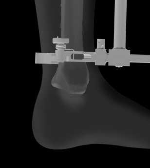 Consejo para la posición de la rodilla Preparación tibial Nota: Las guías de resección tibial ODYSSEY están diseñadas para uso con una hoja de sierra de 1.3mm de grosor.