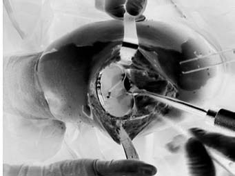 Consejo para la posición de la rodilla Inserción del implante Se inserta el implante de base tibial con el impactor de base tibial (Figura 31).
