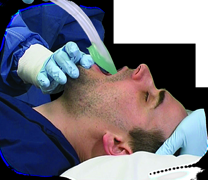 Inducción de la Anestesia conseguir la relajación de la mandíbula del paciente antes de intentar la inserción de i-gel. Una cánula guedel puede ser útil de cara a facilitar la ventilación manual.