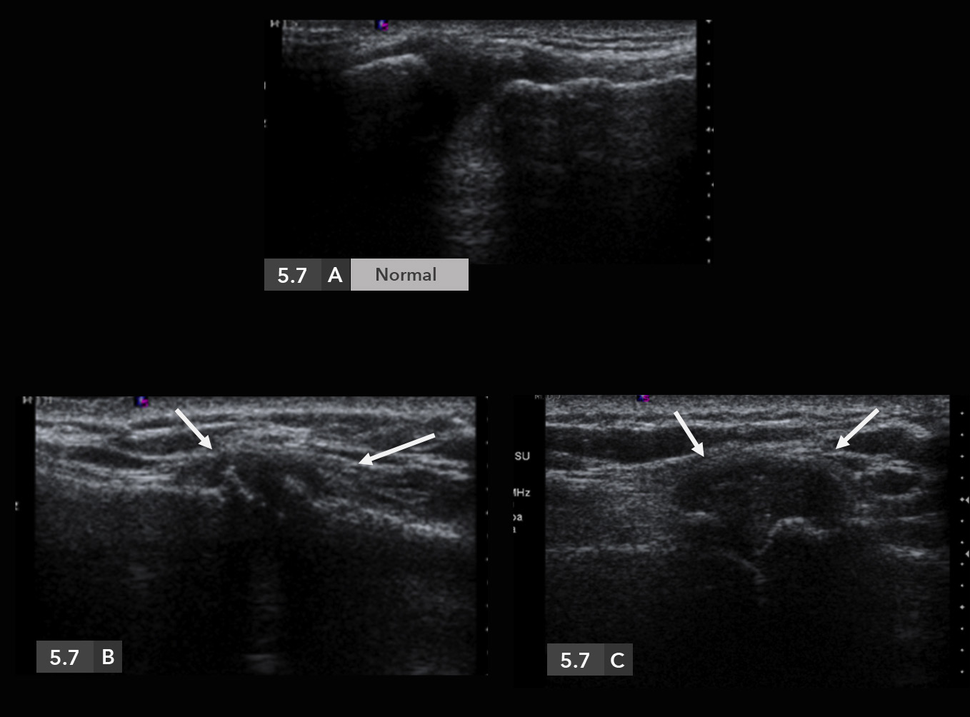 Extremidad superior / Hombro / Dolor de origen articular / Articulación acromioclavicular Caso 5.7. Artrosis acromioclavicular.