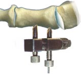 6- Preparación del apoyo la ablación de la arandela ósea se completa con ayuda de una gubia el tercio plantar de la cortical del fragmento proximal se conserva y el hueso esponjoso se elimina con una