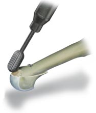 8- Recorte de la visera ósea se mantiene la pinza en su lugar se practica una resección de la visera ósea con ayuda de una pinza de Liston o de una pequeña pinza-gubia entonces se puede retirar la