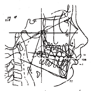 estético de Ricketts, ángulo interincisivo, inclinación y protrusión de incisivos, convexidad facial, altura facial inferior, profundidad facial, ángulo del plano mandibular, arco mandibuar y