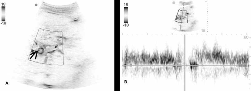 Carrillo Esper R et al. Figura 3. Ultrasonido hepático en donde se observa: A. B. Flujo turbulento a través del stent.