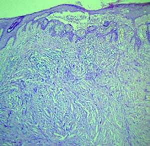 Figura 13. Melanoma maligno desmoplásico con acantólisis incidental.