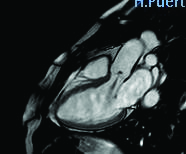 Ilustración 42. Insuficiencia valvular Mitral en un paciente con MCH Septal Asimetrica.Imagen cine-rm 2 cámaras en diástole demuestra un chorro hipointenso proximal al plano de válvula mitral.