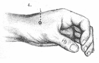 Indicación local: artritis de los dedos. Indicación locorregional: dolores reumáticos en brazo y hombro.