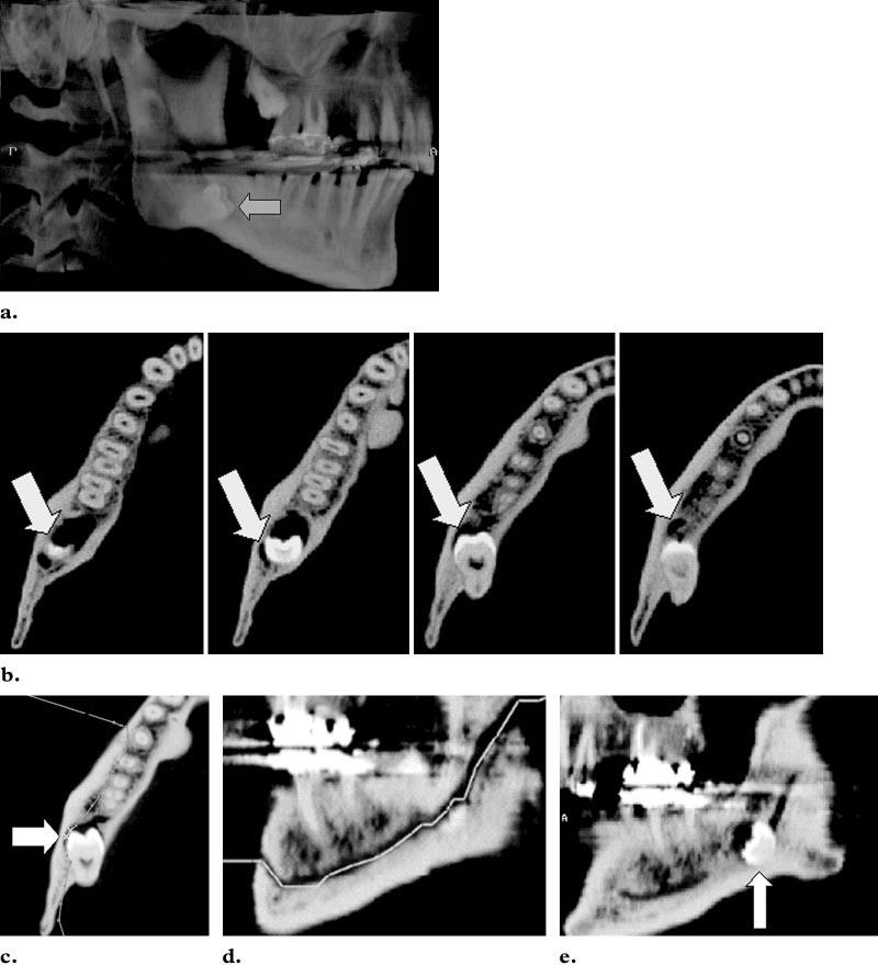 Proceso de reformateado Curvo (a) imagen reformateada de un Volumen Lateral transparente a partir de imágenes axiales muestra un molar impactado (flecha).