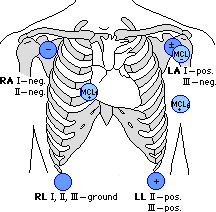 Colocación Estándar De Los Electrodos Para Tomar Un Electrocardiograma De 3 Derivaciones IDENTIFICACION DE LOS CABLES: RA (right arm):derecha.