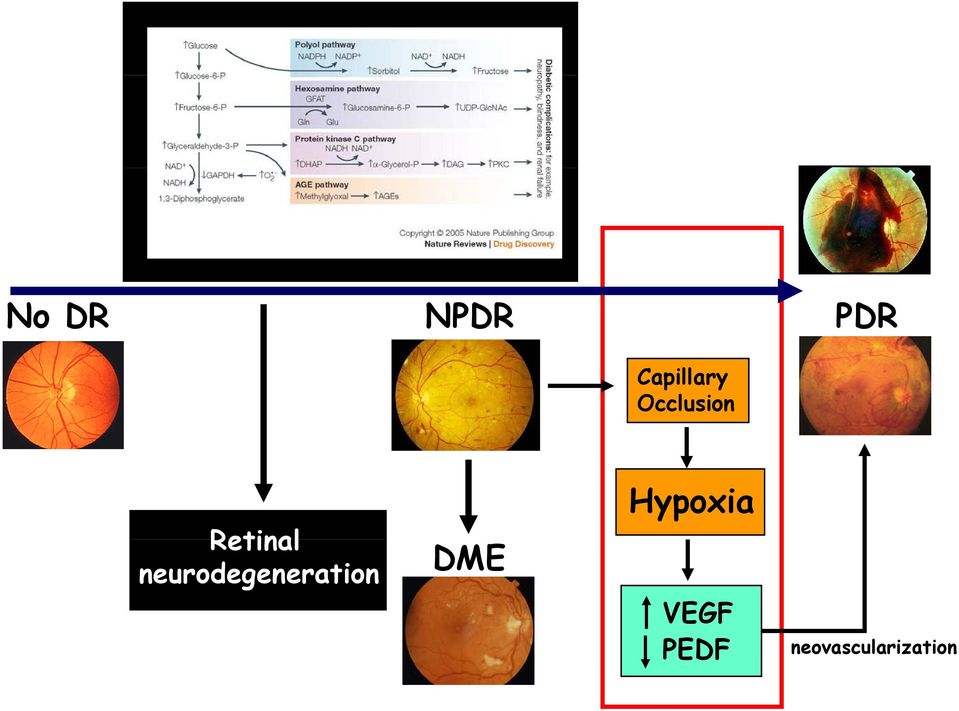 neurodegeneration DME