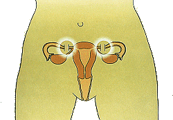 Comparación de la efectividad típica de los métodos anticonceptivos Generalmente 2 o menos embarazos por cada 100 mujeres en un año Más efectivo Implantes DIU Inyectables Esterilización femenina