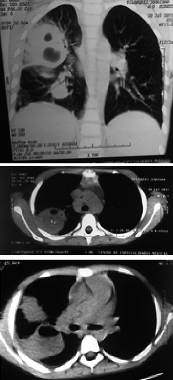 Neumol Pediatr 2013; 8 (1): 5-9. A B C Figura 2. TAC de tórax de escolar de 9 años de edad de hidatidosis pulmonar. Apreciándose imágenes cavitadas con nivel hidroaéreo a nivel del pulmón derecho.