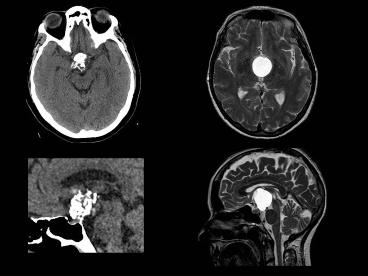 Fig. 32: Craneofaringioma. Imagenes en TC sin contraste y RM (secuencia T2).