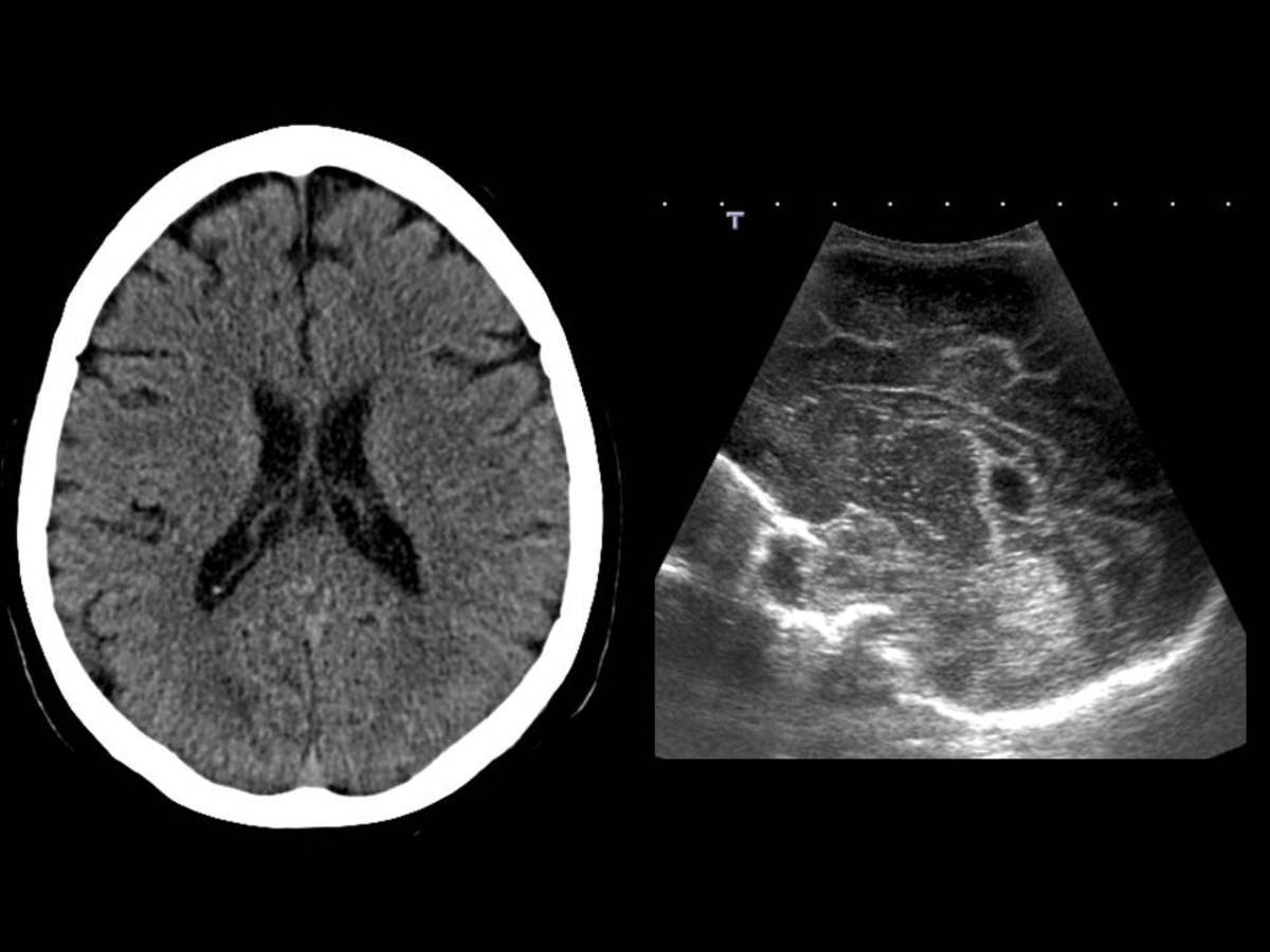 Fig. 3: Cavum Velum Interpositum. Imagen de TC: Imagen en línea media, triangular entre ambos ventrículos y densidad similar al líquido cefaloraquídeo.