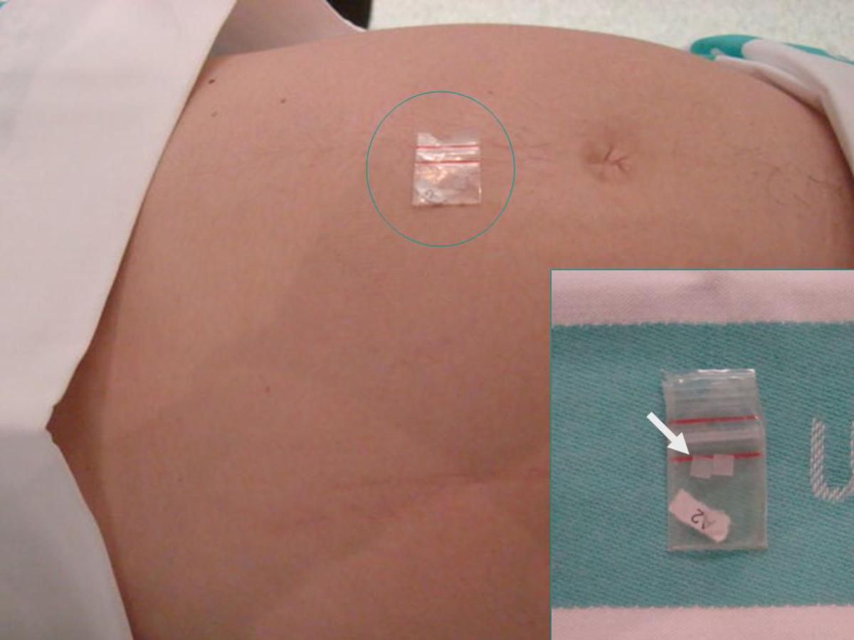 Fig. 6: Colocación de TLD (flecha blanca) en la piel de la paciente.