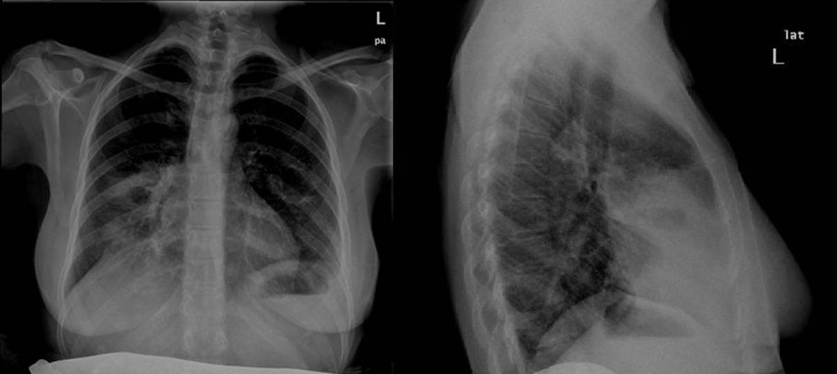 Fig. 9: Control postquirúrgico mediante radiografía simple AP y L de tobillo D en gestante de 26 semanas, sin parrilla antidifusora y con mandil plomado. Fig.