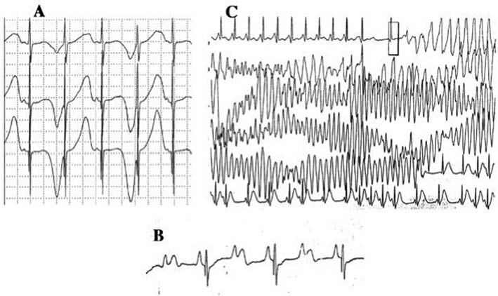 Fig. 4. Alteraciones electrocardiográficas en el síndrome del QT largo. A: alternancia eléctrica de la onda T. B: bloqueo auriculoventricular 2:1. C: torsade de pointes autolimitada.