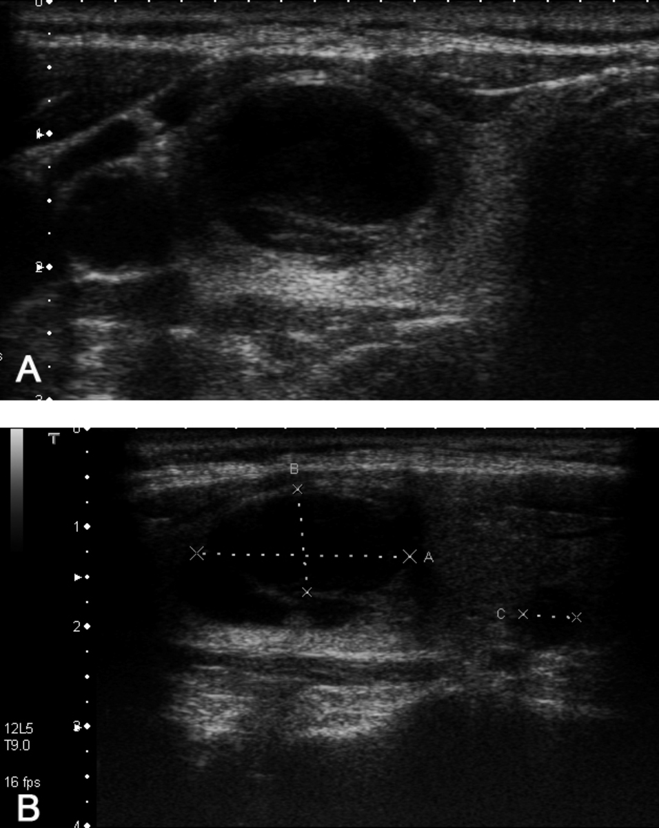 Fig. 5: Imágenes transversal(a) y longuitudinal(b) de una ecografía tiroidea en un paciente con un bocio multinodular.