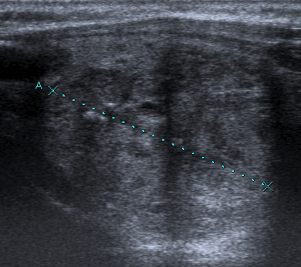 Fig. 9: Nódulo coloide de gran tamaño situado en el lóbulo tiroideo izquierdo.