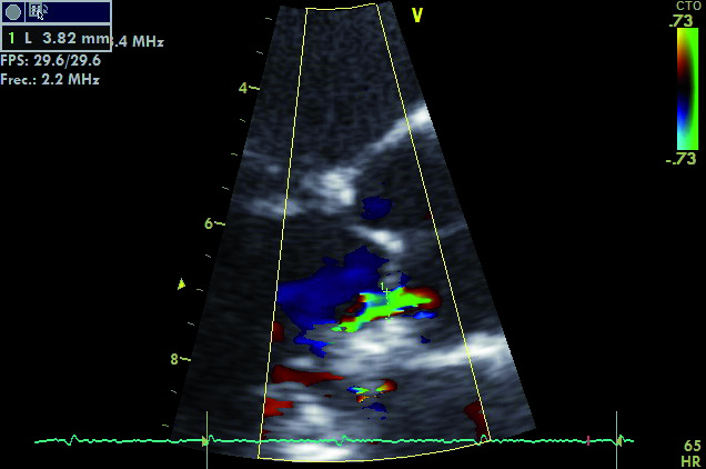 Ecocardiograma-Doppler color Imagen donde se observa el