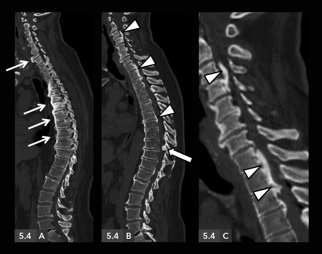 Columna vertebral / Espondiloartropatías inflamatorias / Hiperostosis esquelética idiopática difusa 5.