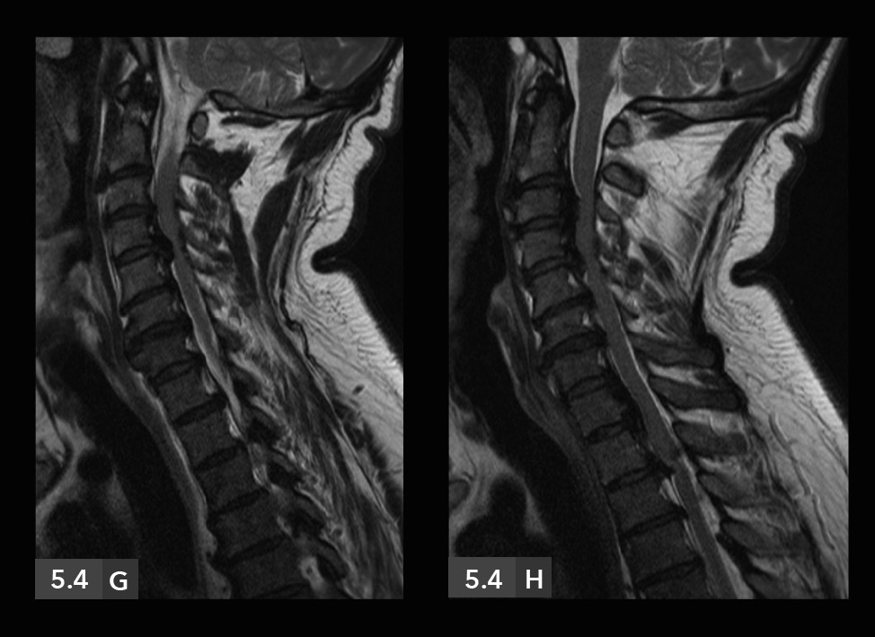 Columna vertebral / Espondiloartropatías inflamatorias / Hiperostosis esquelética idiopática difusa 5.4 A-H. Hiperostosis esquelética idiopática difusa Figura 5.