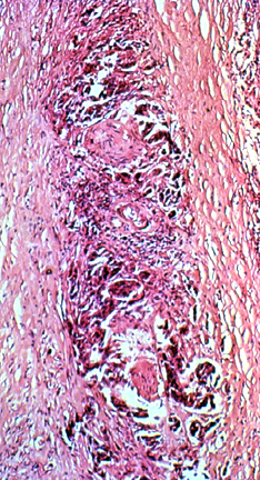 Displasia Anomalías en el tamaño y apariencia celulares, con o sin un patrón de crecimiento desorganizado