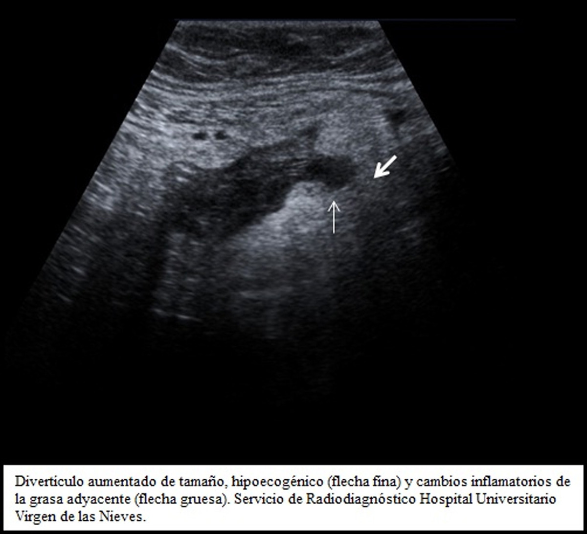 Fig. 2: Engrosamiento parietal circunferencial hipoecogénico de la pared del colon. Servicio de Radiodiagnóstico, Hospital Universitario Virgen de las Nieves, Granada. Fig.