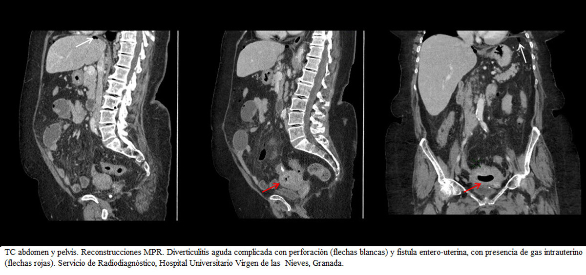 Fig. 6: TC de abdomen y pelvis. Reconstrucciones MPR.
