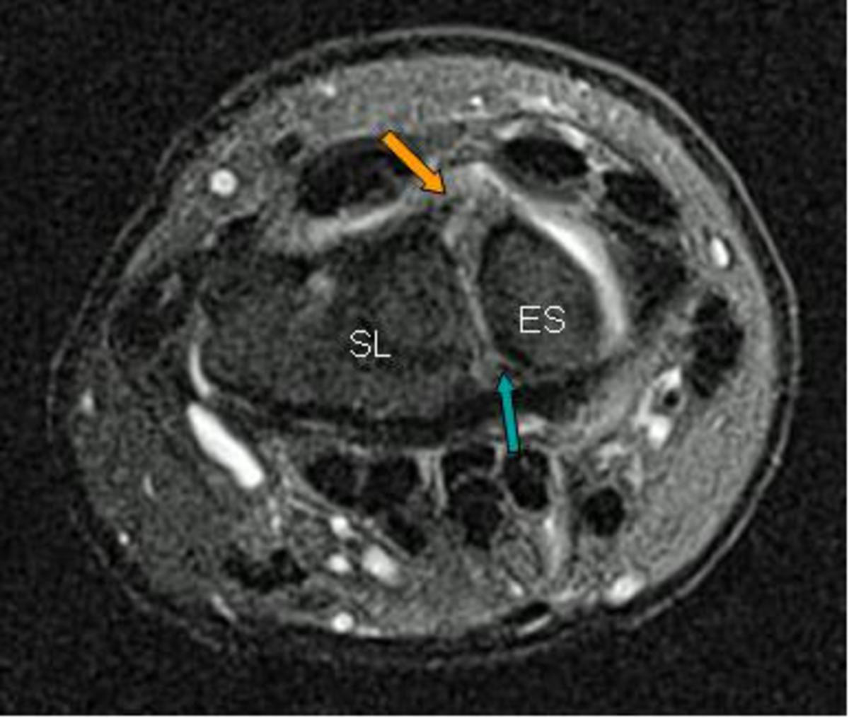 Fig. 6: Estudio dinámico mediante fluoroscopia donde se pone de evidencia la inestabilidad de la articulación escafo-semilunar cuando el paciente fuerza el movimiento en el que percibe un "click"
