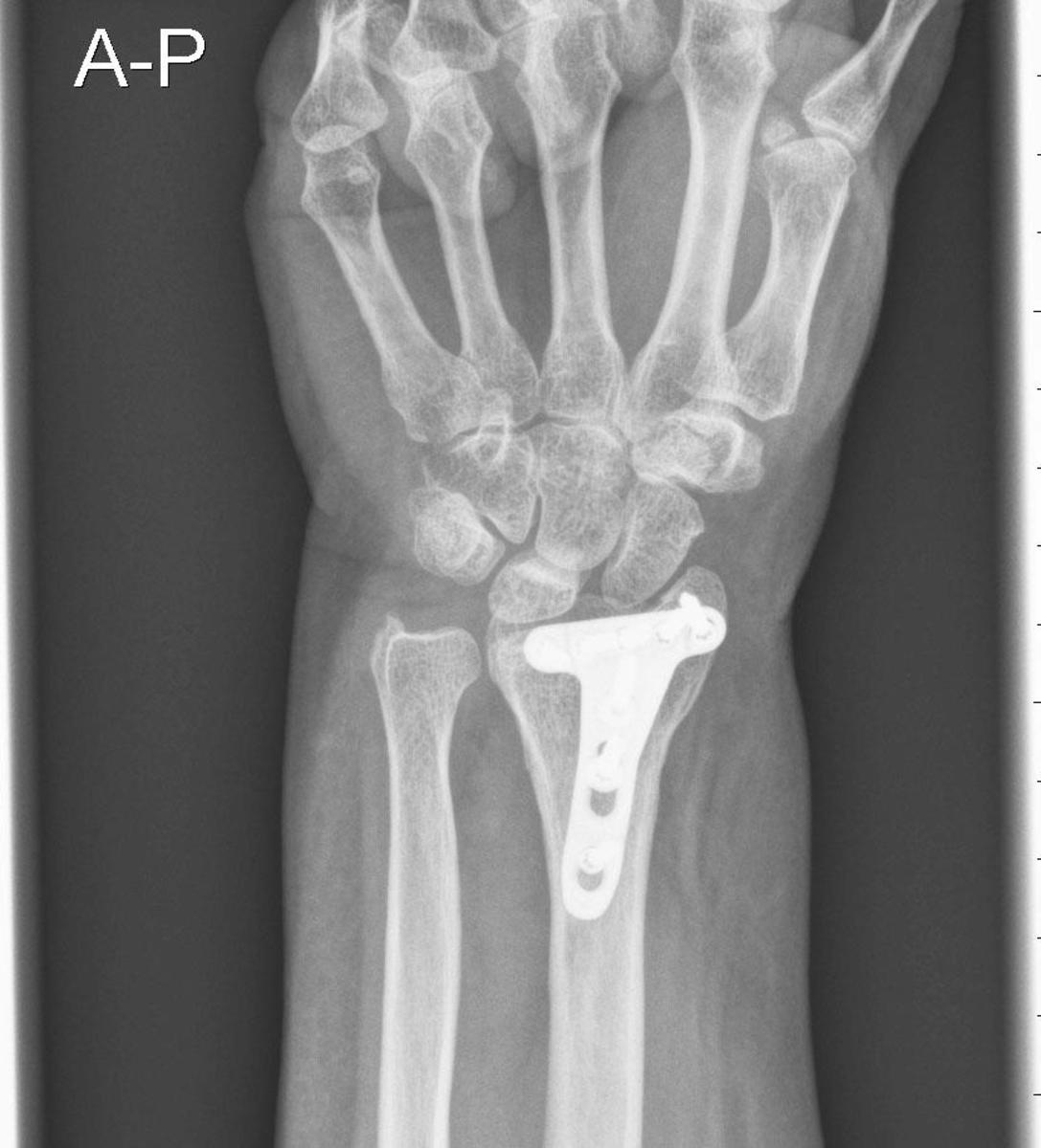 Fig. 3: Sin embargo, la lesión del ligamento escafosemilunar se pone de manifiesto por el aumento del "gap" articular en la