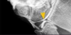 Lesión de Complejo fibrocartílago triangular Masculino con dolor cubital de