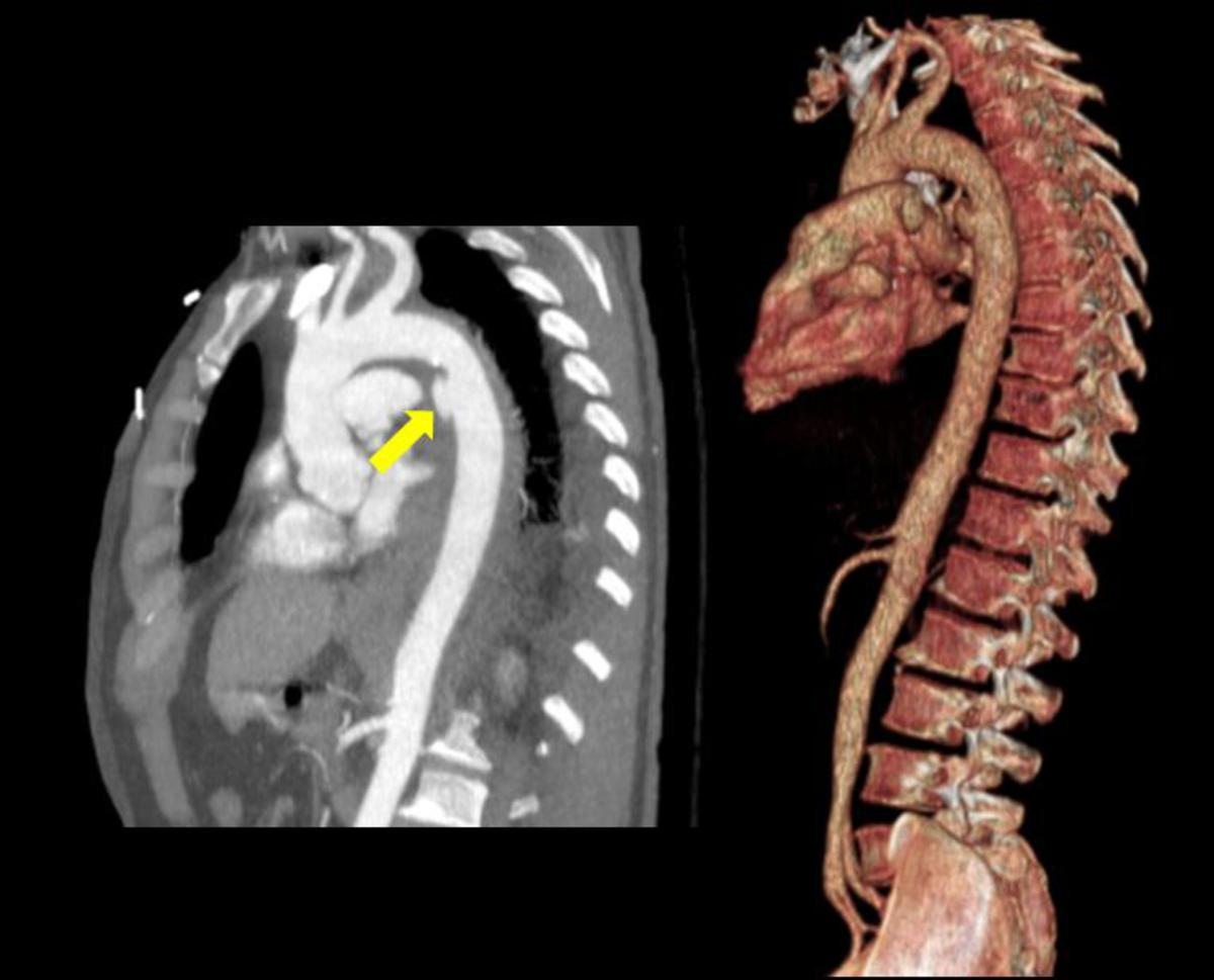 Fig. 15: Imagen 15. Reconstrucción MIP sagital y 3D del paciente anterior.