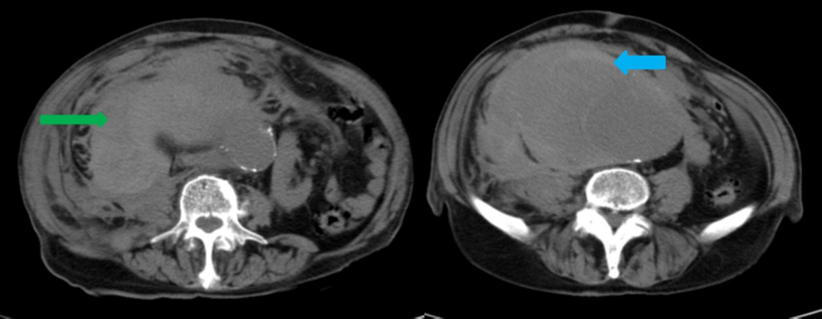 Fig. 1: Imagen 1. TC axial sin C.I.V y reconstrucción coronal con C.I.V. de un varón de 76 años que acude a urgencias por dolor abdominal y pérdida de consciencia.