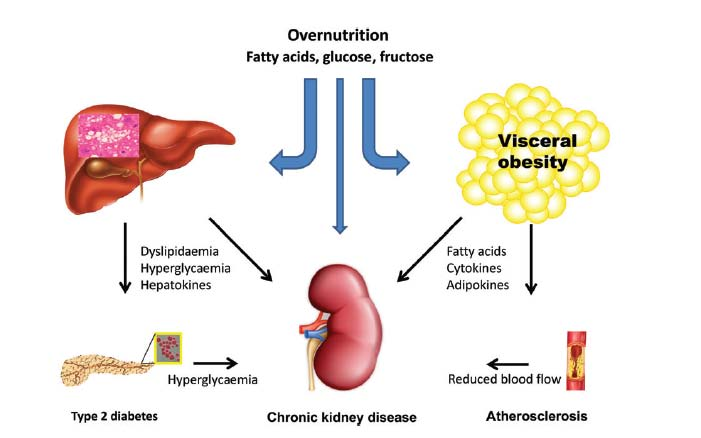 Efectos de la Obesidad sobre el riñón Mecanismos biológicos Daño directo: Daño Indirecto: - efectos hemodinámicos - efectos hormonales -