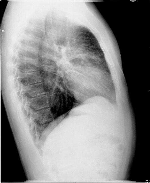 Hilio pulmonar Esternón Arco posterior de costilla Silueta cardíaca Cúpula