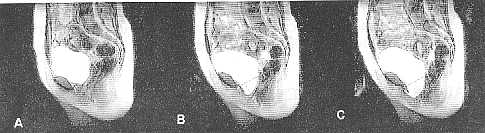Resonancia magnética dinámica en la incontinencia urinaria 143 Figura.3. Cortes coronales en el plano uretral (A), vaginal (B) y posterior a la vagina (C).