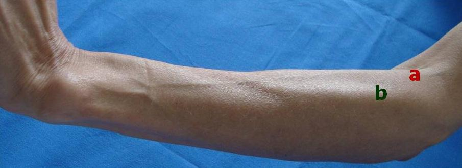 En el antebrazo, los músculos de la región lateral son: músculo braquiorradial o supinador largo, extensor radial largo del carpo y extensor radial corto del carpo.