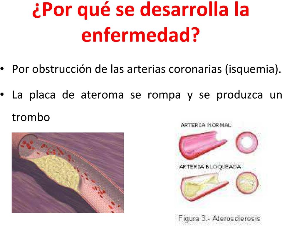 coronarias (isquemia).