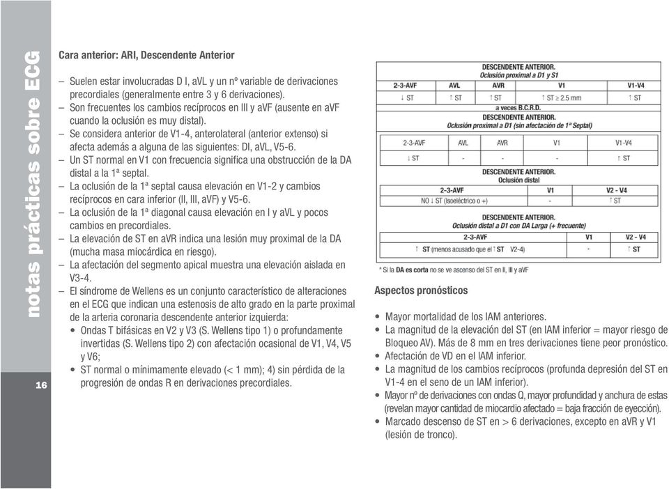 Se considera anterior de V1-4, anterolateral (anterior extenso) si afecta además a alguna de las siguientes: DI, avl, V5-6.