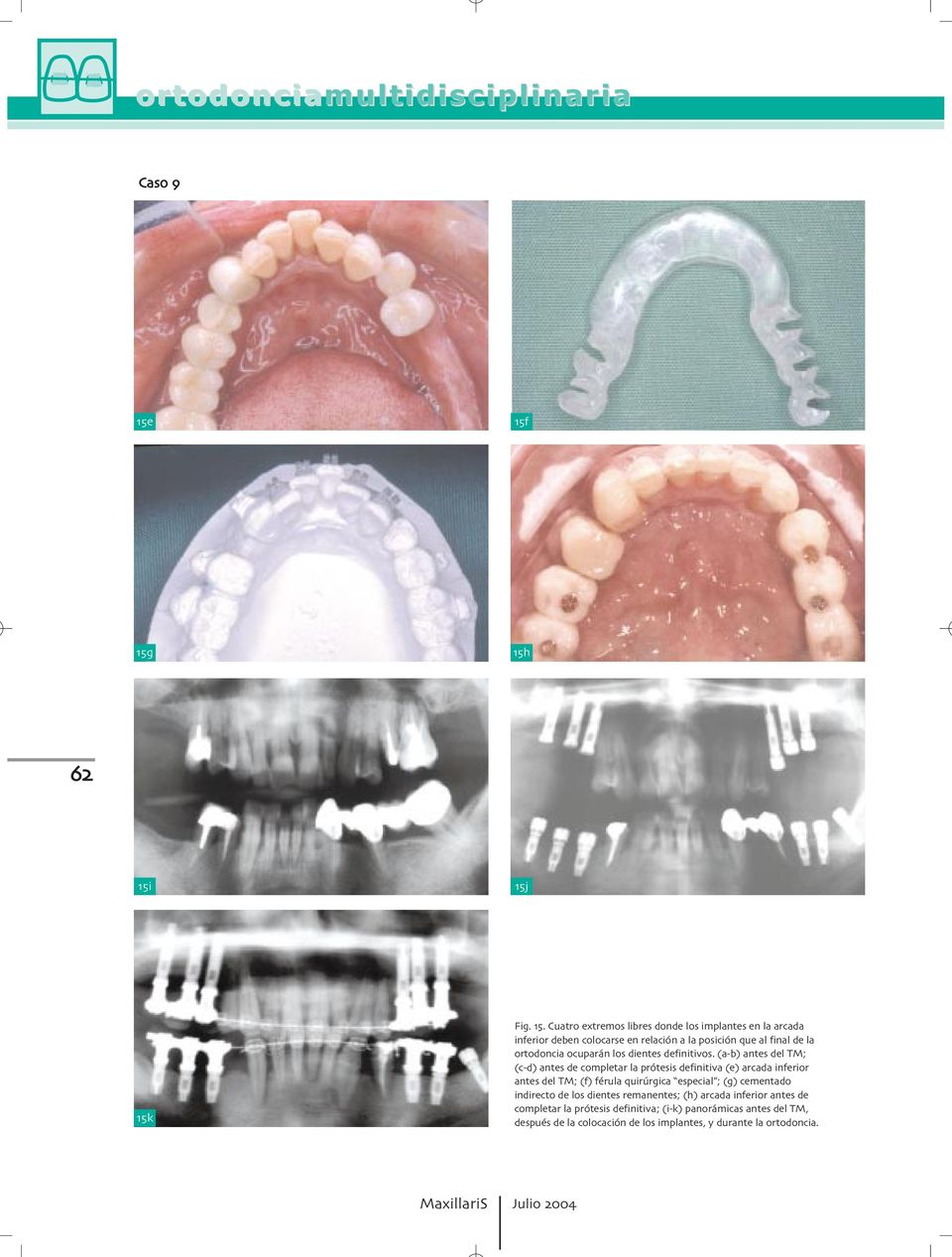 ortodoncia ocuparán los dientes definitivos.