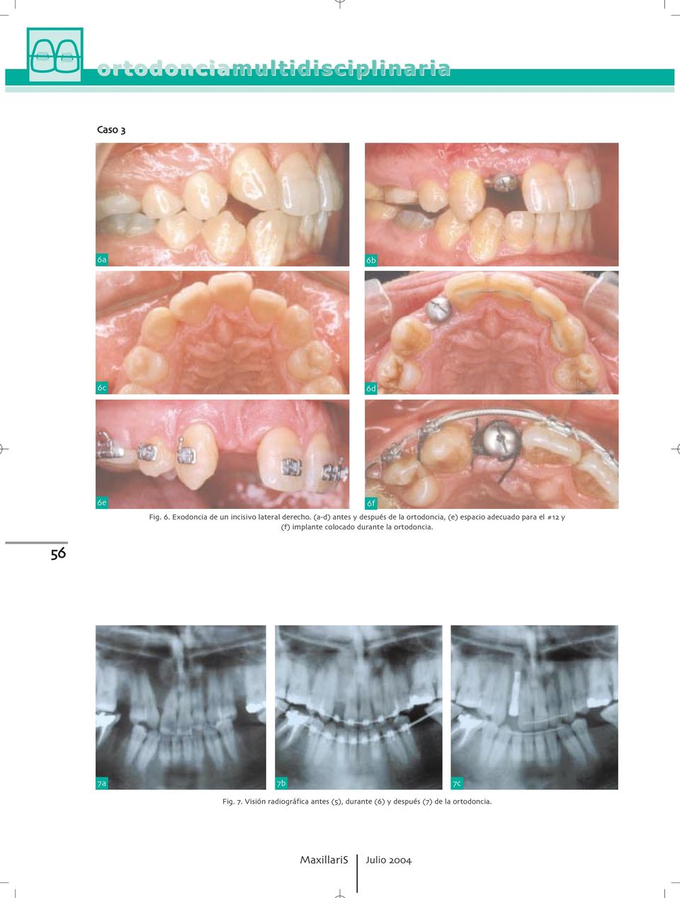para el # y (f) implante colocado durante la ortodoncia. f Fig.