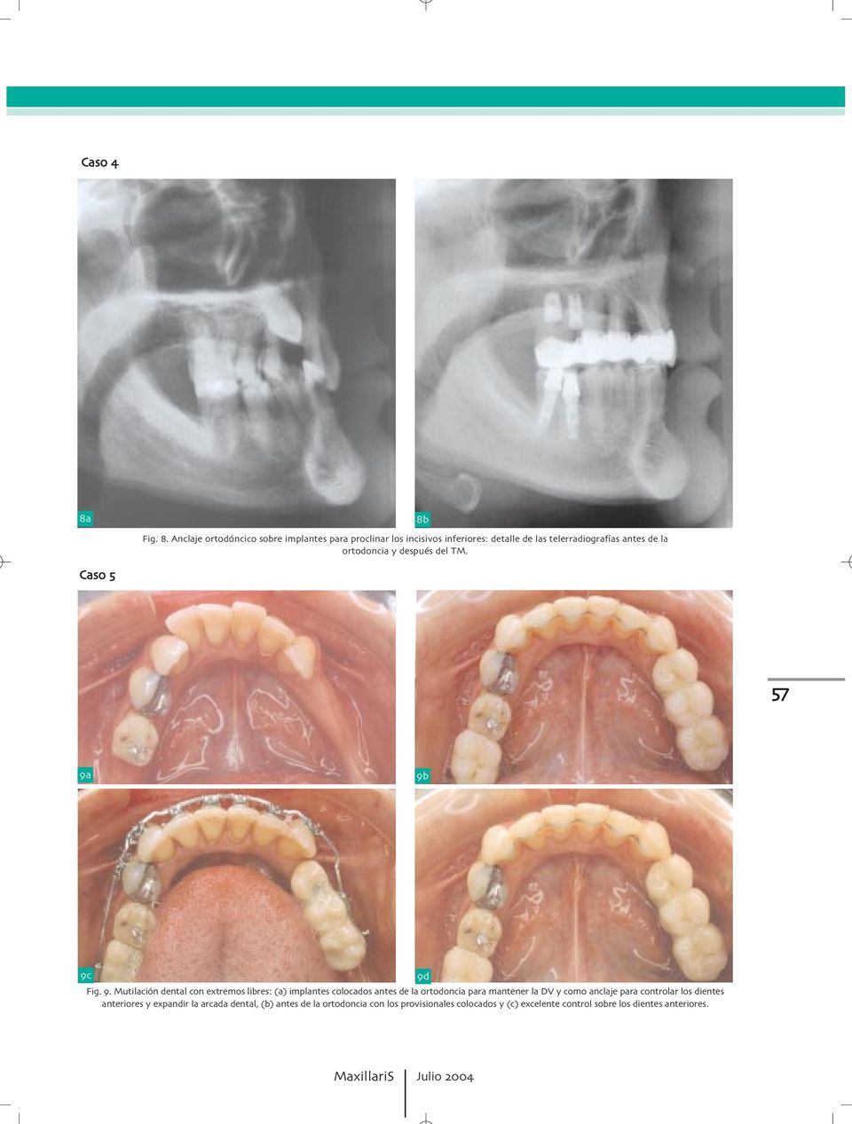 . Mutilación dental con extremos libres: (a) implantes colocados antes de la ortodoncia para mantener la DV y como