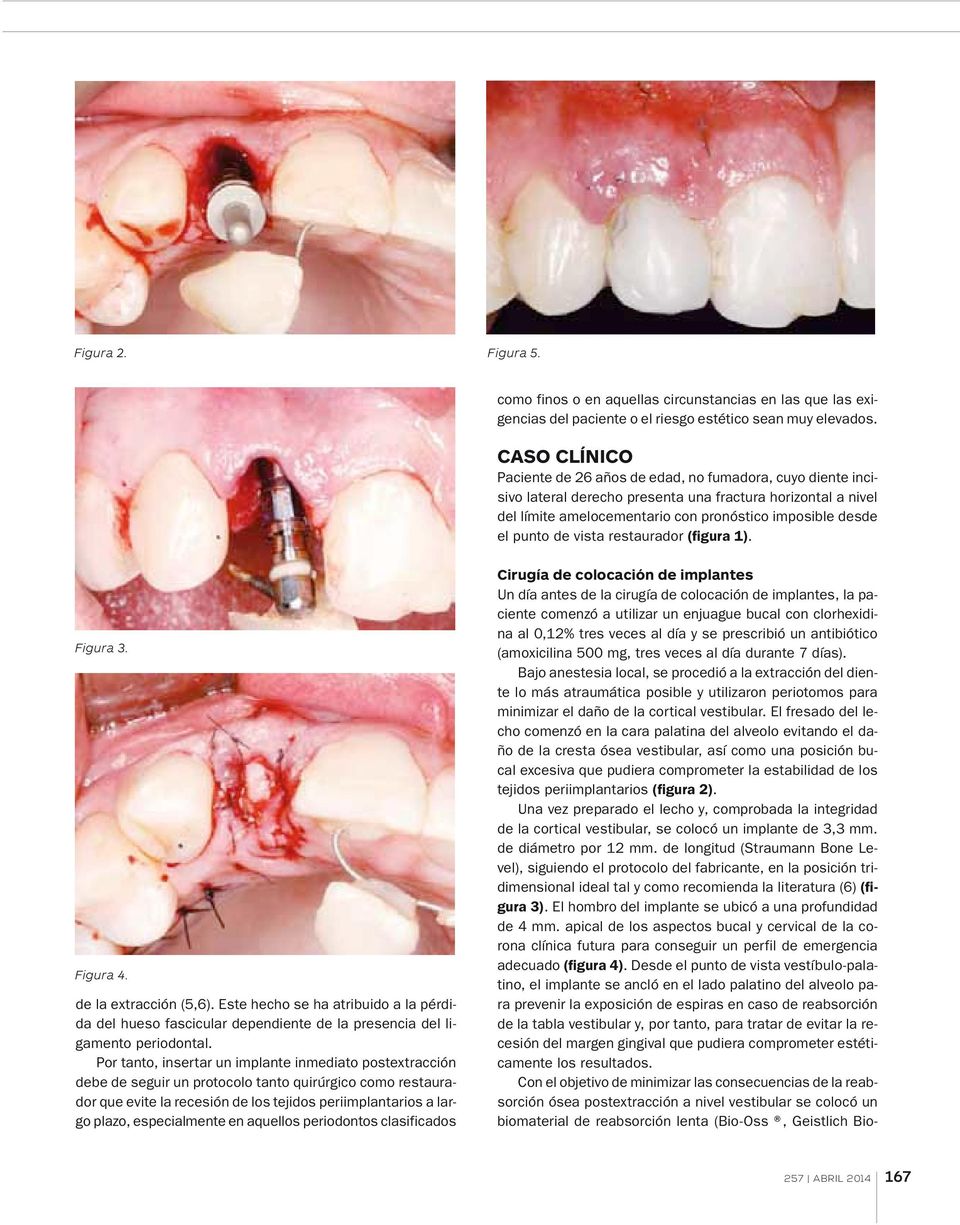 de vista restaurador (figura 1). Figura 3. Figura 4. de la extracción (5,6). Este hecho se ha atribuido a la pérdida del hueso fascicular dependiente de la presencia del ligamento periodontal.