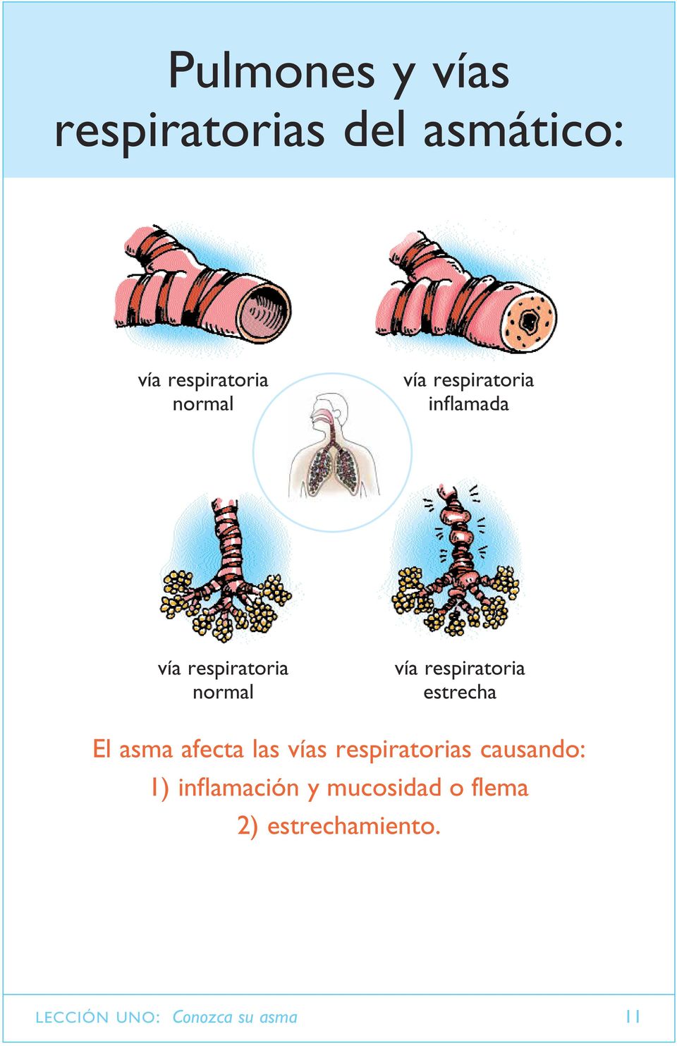 estrecha El asma afecta las vías respiratorias causando: 1)