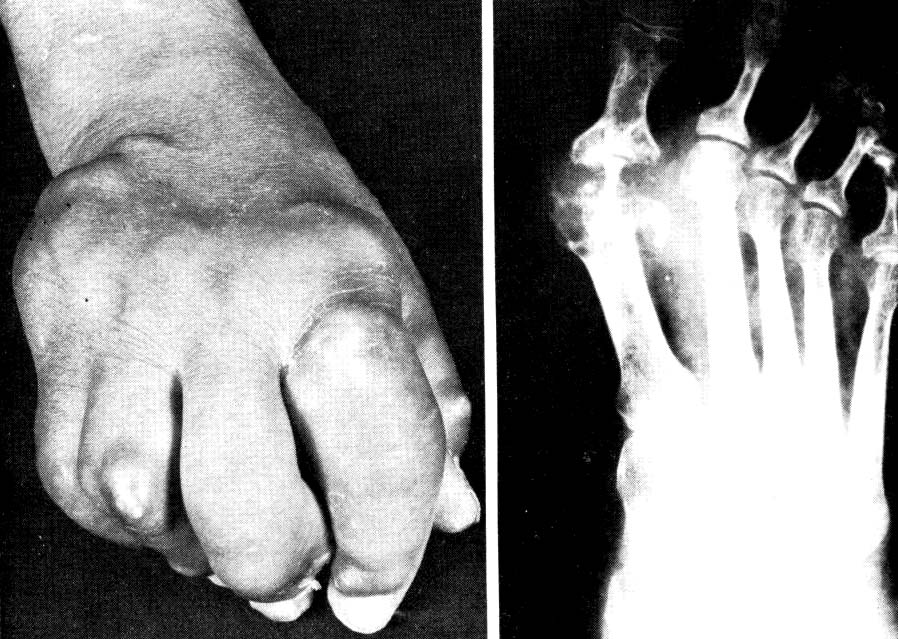 Sinovial de un hombre de 46 años con gota, que había sufrido ataques repetidos de artritis gotosa durante 15 años. Obsérvense los numerosos depósitos tofáceos (flechas) Gota tofácea crónica.