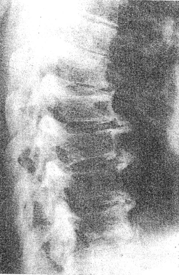 Esquema de las vértebras cervicales ilustrando la situación de las articulaciones uncovertebrales de Luschka Región dorsal en la hiperostosis anquilosante.