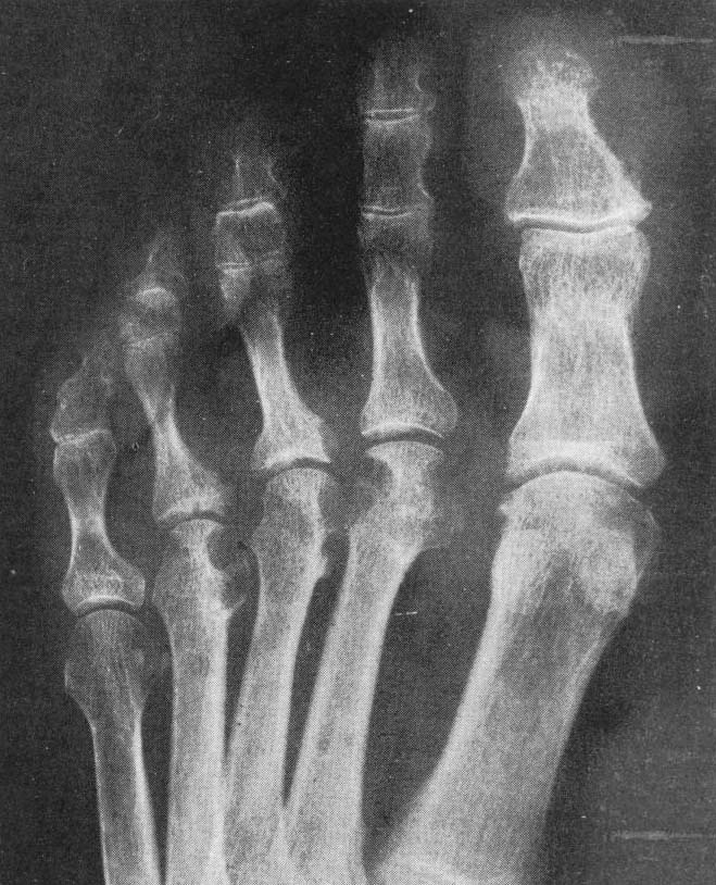 Sinovitis reumatoide. Sinovial hiperplástica obtenida de la rodilla de una muchacha de 16 años afectada de artritis reumatoidea precoz.